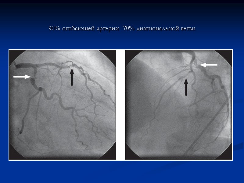 90% огибающей артерии  70% диагнональной ветви